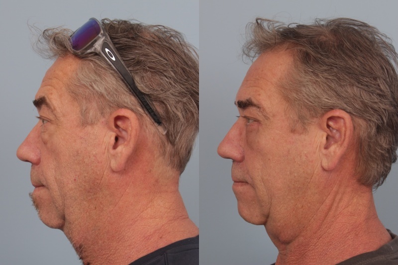 before_after_img