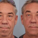 blepharoplasty-merged
