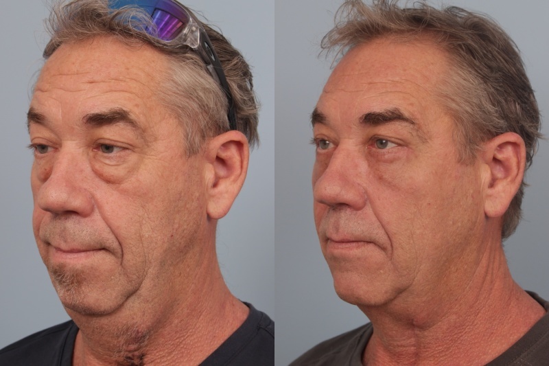 before_after_img
