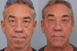 before and after blepharoplasty