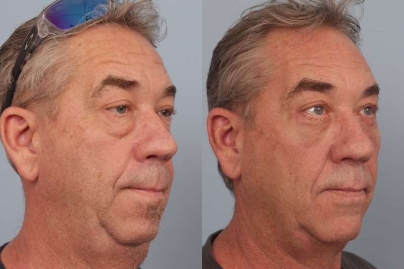before_after_img