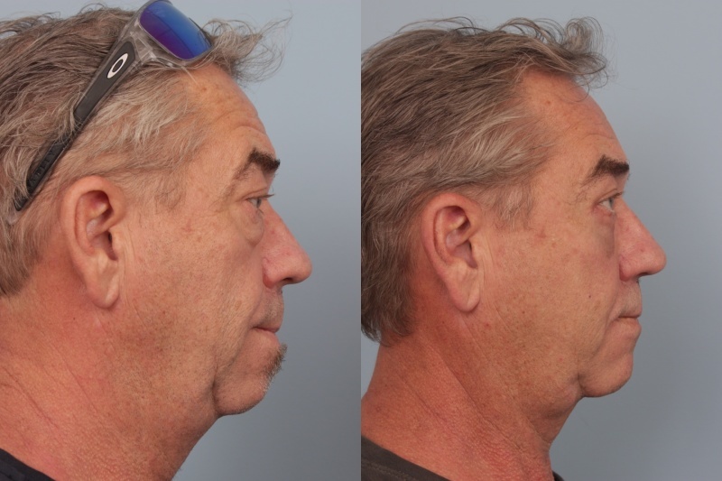 before_after_img