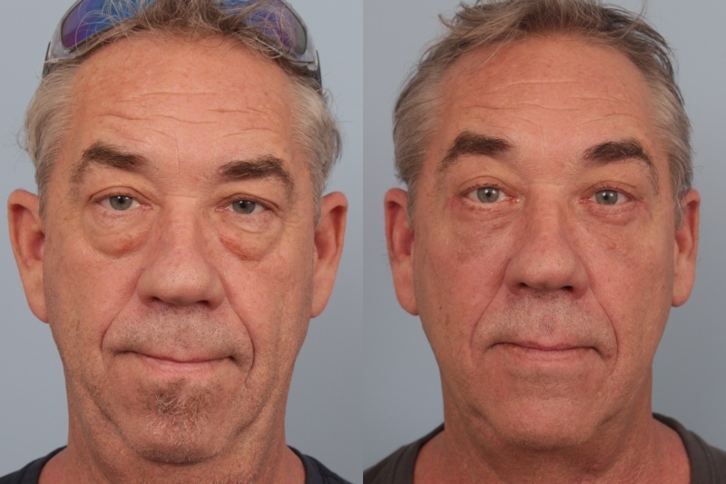before_after_img