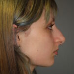 rhinoplasty-before