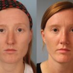 rhinoplasty-merged