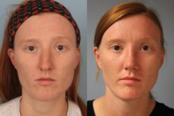 before and after rhinoplasty