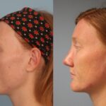 rhinoplasty-merged