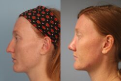 before and after rhinoplasty