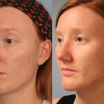rhinoplasty-merged
