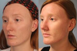 before and after rhinoplasty