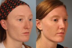 before and after rhinoplasty