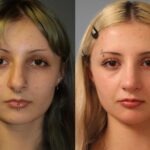 rhinoplasty-merged