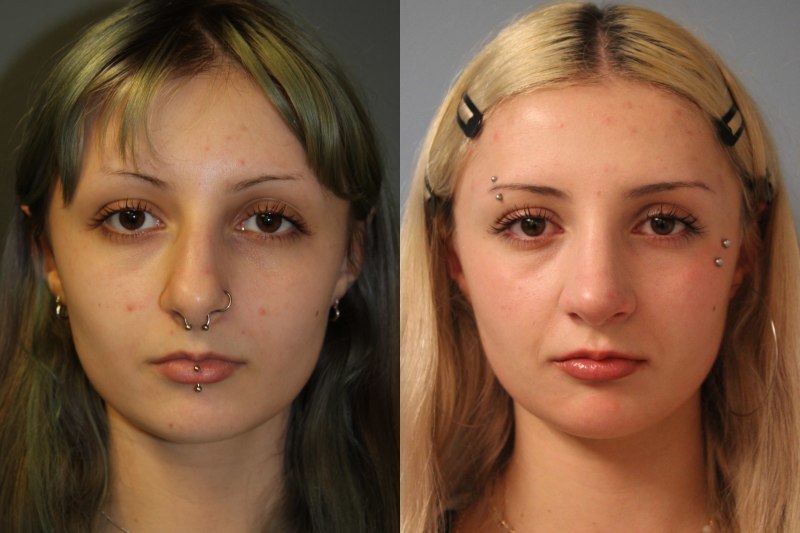 before_after_img