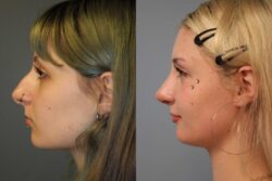 before and after rhinoplasty