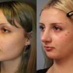 rhinoplasty-merged