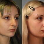 rhinoplasty-merged