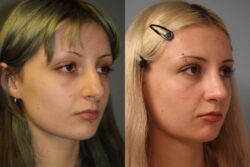 before and after rhinoplasty
