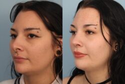 before and after rhinoplasty