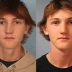 rhinoplasty-merged