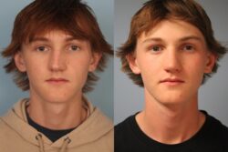 before and after rhinoplasty