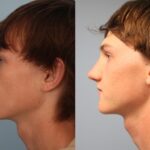 rhinoplasty-merged