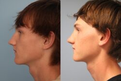 before and after rhinoplasty