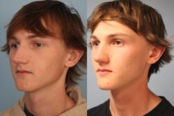 before and after rhinoplasty