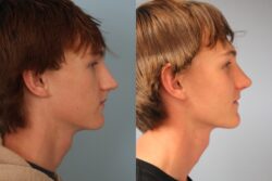 before and after rhinoplasty