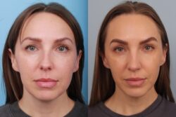 before and after rhinoplasty