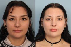 before and after rhinoplasty