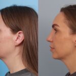 rhinoplasty-merged
