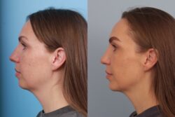 before and after rhinoplasty
