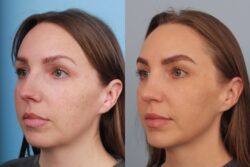 before and after rhinoplasty