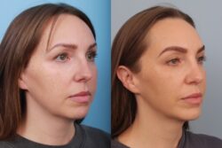 before and after rhinoplasty