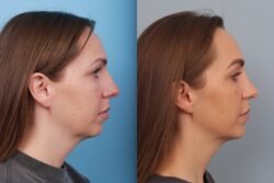 before and after rhinoplasty