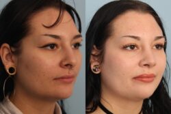 before and after rhinoplasty