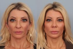 before and after rhinoplasty