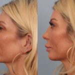 rhinoplasty-merged
