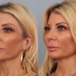 rhinoplasty-merged