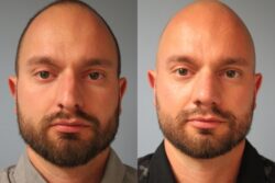 before and after rhinoplasty