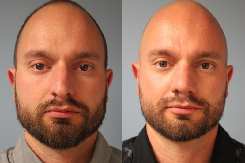 before_after_img