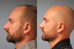 before and after rhinoplasty