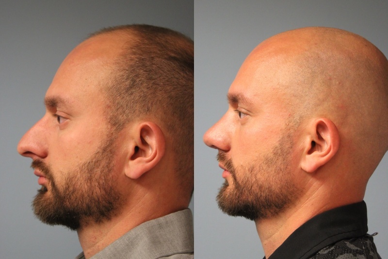 before_after_img