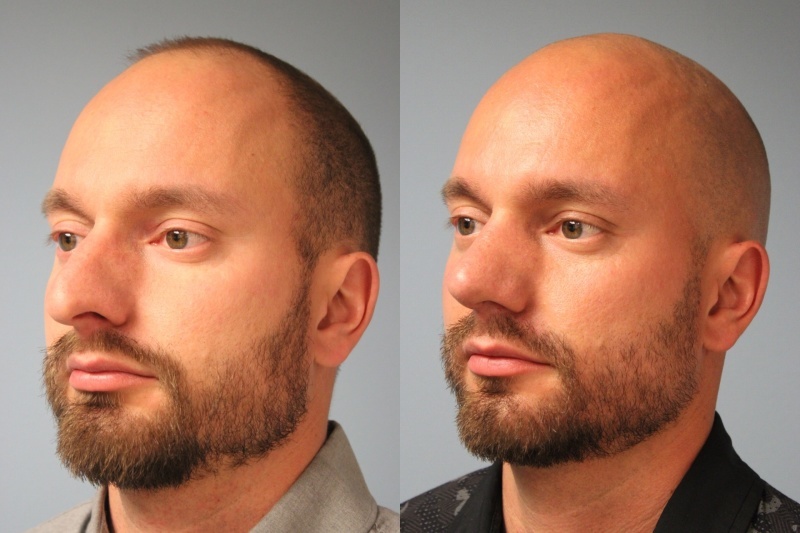 before_after_img