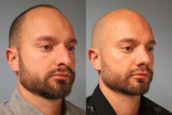 before and after rhinoplasty