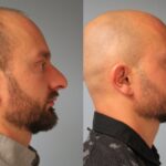 rhinoplasty-merged