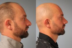before and after rhinoplasty