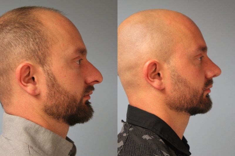 before_after_img
