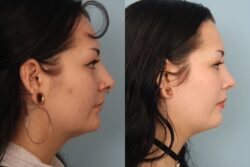 before and after rhinoplasty