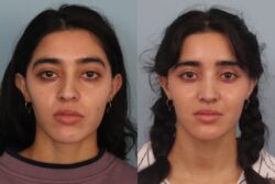 before and after rhinoplasty